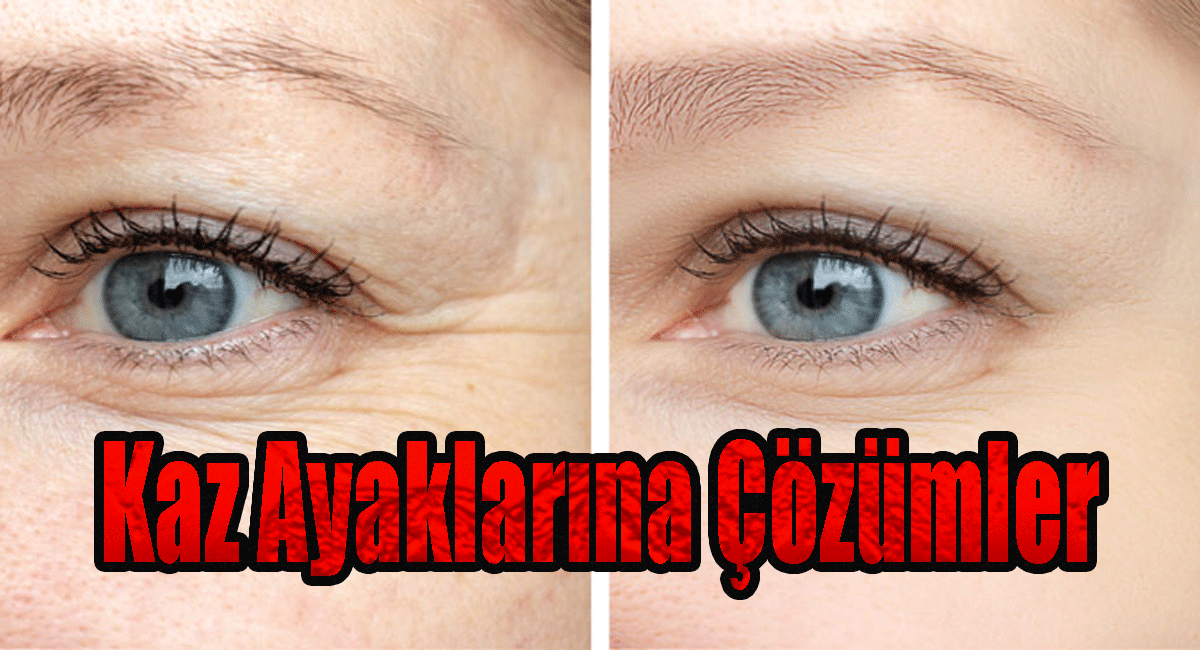 Kaz Ayaklarına Çözümler