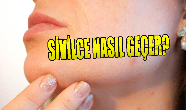 Sivilce Lekeleri Nasıl Geçer?